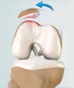 Return to Play Considerations After Patellar Instability