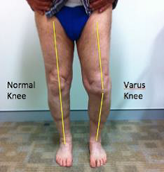 Illustrative Clinical Knee Examination: Observation and Bony Palpation
