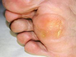 Hyperkeratosis of the Foot:  Part 1