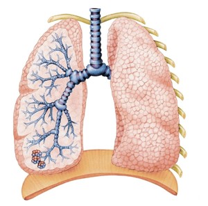 Pulmonary Rehabilitation for Management of COPD