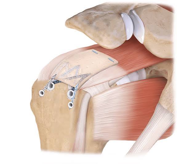 Consensus Recommendations for Clinical Practice and Research after Rotator Cuff Repair