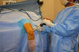 Neurostimulation Device for the Treatment of Pain and Function following Elbow Surgery