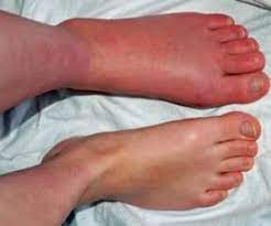 Complex Regional Pain Syndromes (CPRS) Type 1 Validating Case Histories