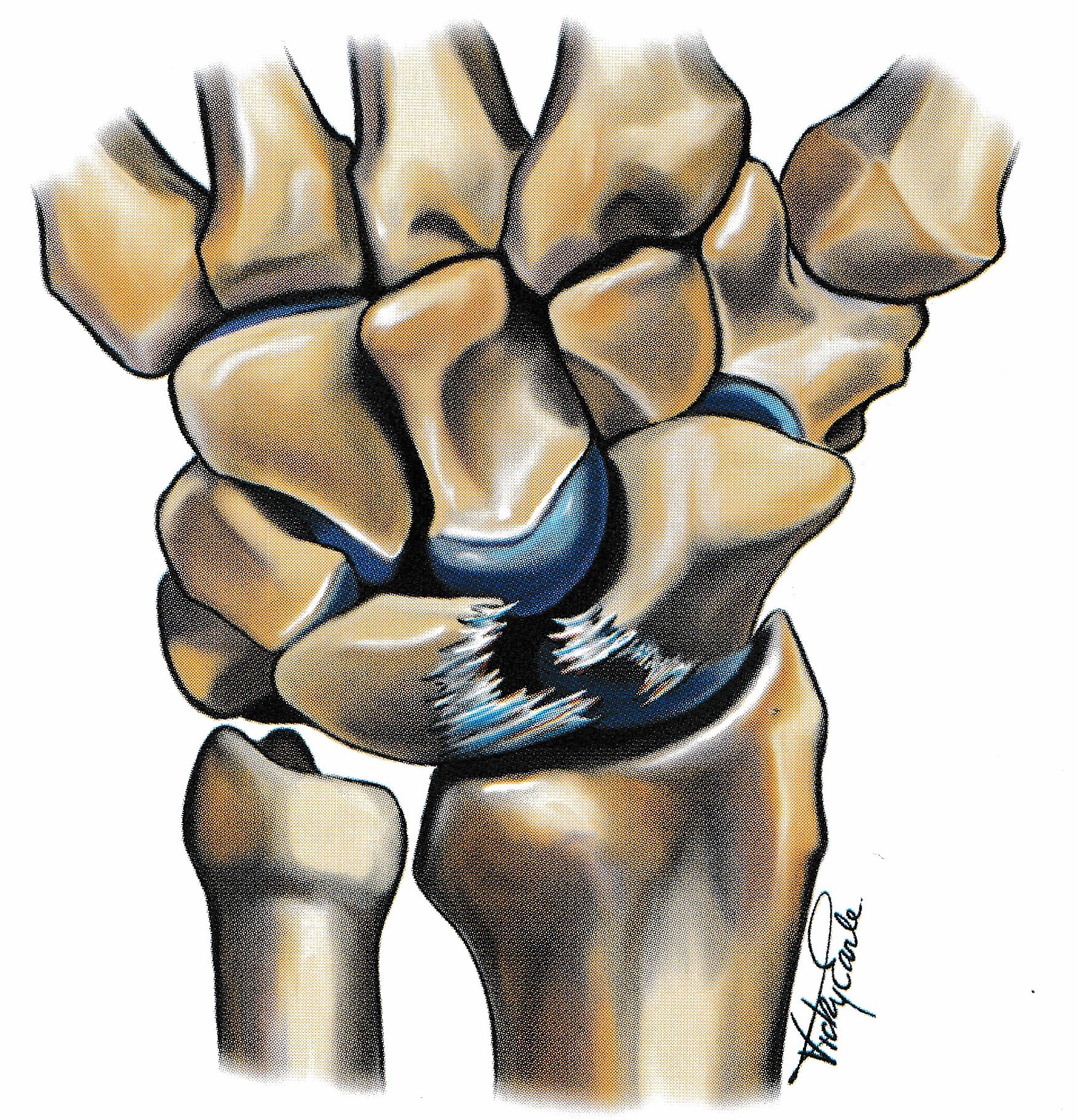 Wrist Pain:  Part 2 - Traumatic and Overuse Wrist Conditons