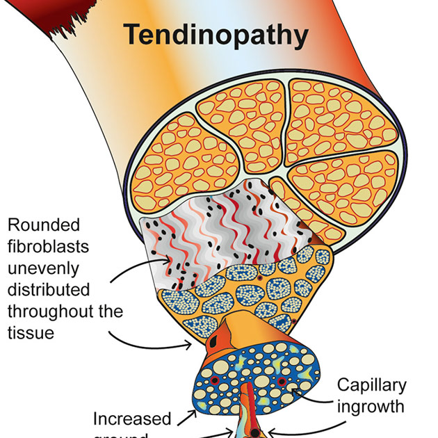 Tendinopathy Rehabilitation