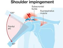 Subacromial Impingement Syndrome of the Shoulder: A Musculoskeletal Disorder or a Medical Myth?