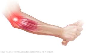 Physiotherapy Management of Tennis Elbow