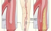 Peripheral vascular disease can mimic a musculoskeletal problem like lumbar stenosis. How do you differential diagnose lumbar stenosis versus intermittent claudication due to vascular deficits?