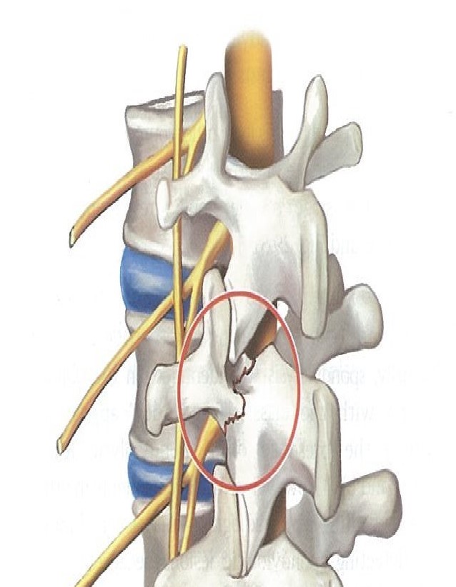 Management of Specific Low Back Pain Disorders