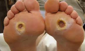 The Diabetic Foot: Pathophysiology, Evaluation, and Treatment