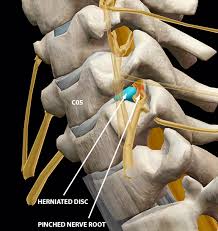 The Presence and Prognosis of Nerve Pathology following Whiplash Injury: A Prospective Cohort Study