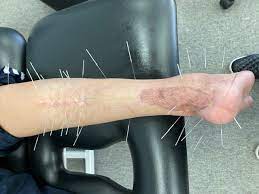 Dry Needling for Fascia, Scar and Tendon