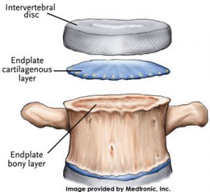 MRI Vertebral Endplate Changes