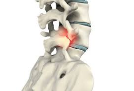 Rehabilitation of Lumbar Bone Stress Injuries in Tennis Players